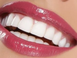 What Would You Give For A Hollywood Smile?